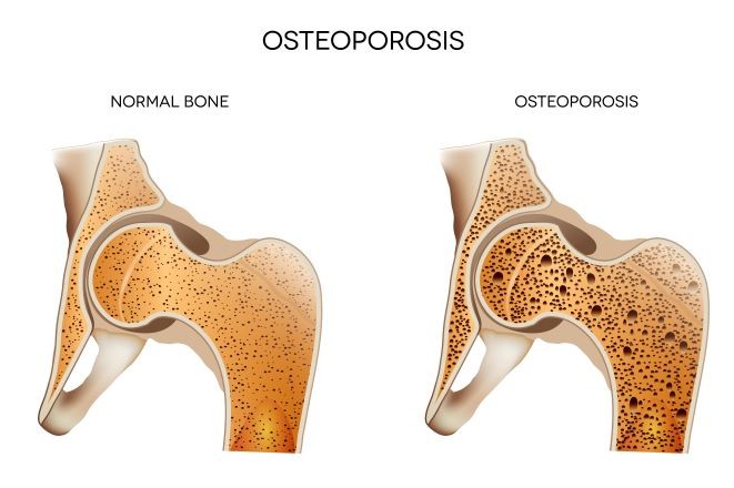 Normal Bone vs Osteoporosis