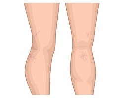 Spider Veins