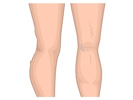 Varicose Veins